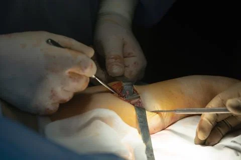 Plate Inside the Arm Stockfoto's