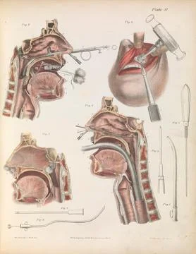 Plate LI. Surgery on the cavities of the face and throat. Stock Illustration
