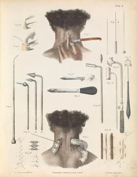 Plate VI. Various instruments and techniques used in surgery. Illustration .. Stock Illustration