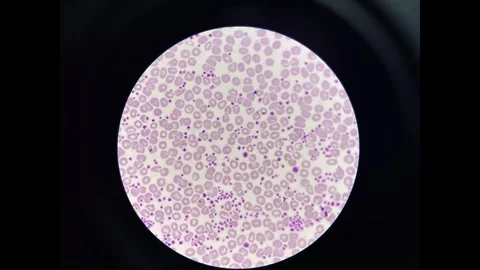 The platelets appear as small, irregularly shaped. Stock Footage 307102378