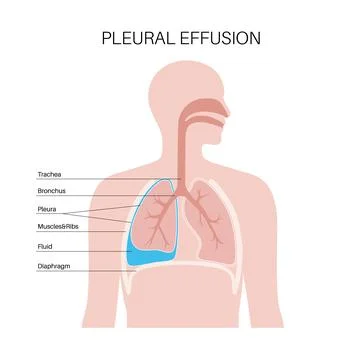 Pleural effusion poster Stock Illustration