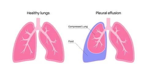 Pleural effusion poster イラスト素材