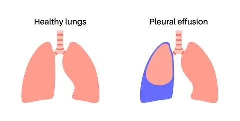 Pleural effusion poster Stock Illustration
