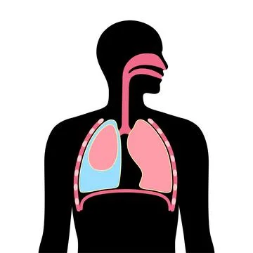 Pleural effusion poster Stock Illustration