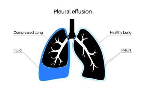 Pleural effusion poster Ilustración de archivo