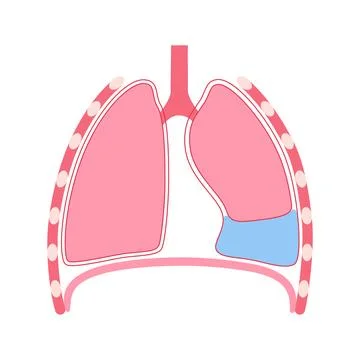 Pleural effusion poster Stock Illustration