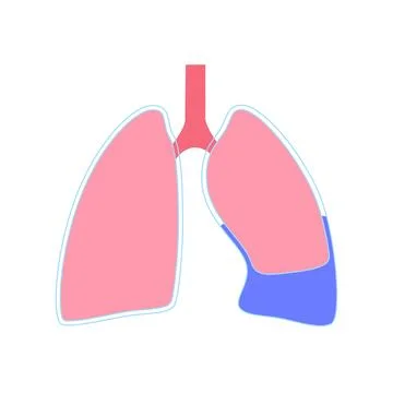 Pleural effusion poster Ilustración de archivo
