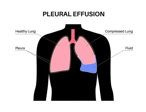 Pleural effusion poster Stock Illustration