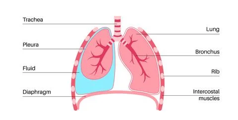 Pleural effusion poster Illustrazione stock