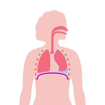 Pleural effusion poster Illustrazione stock