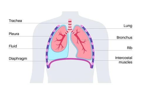 Pleural effusion poster Stockillustratie