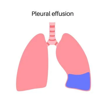 Pleural effusion poster Stock Illustration