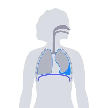 Pleural effusion poster Ilustración de archivo