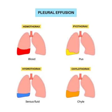 Pleural effusion poster Stock Illustration