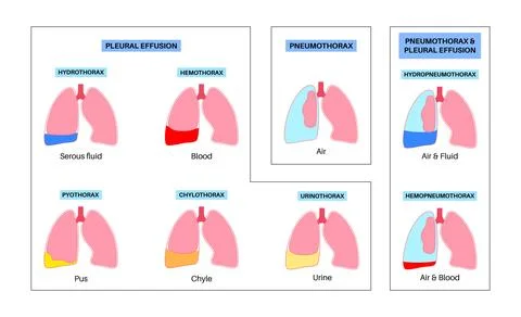 Pleural effusion poster Stock Illustration