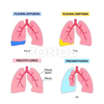 Pleural effusion poster ~ Clip Art ~ Download Now #239101619