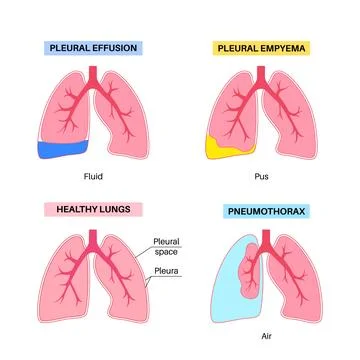 Pleural effusion poster Stock Illustration