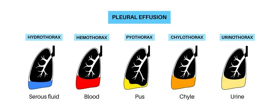 Pleural effusion poster Stock Illustration