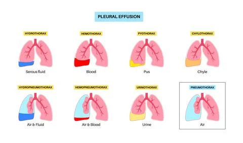 Pleural effusion poster Stock Illustration