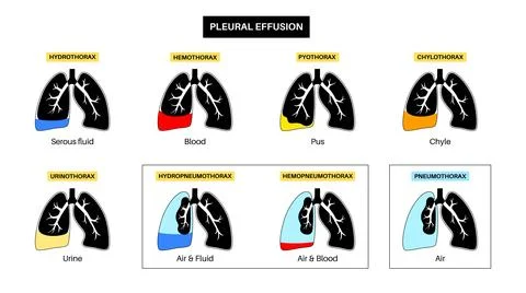 Pleural effusion poster Stock Illustration