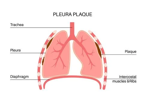 Pleural plaque poster イラスト素材