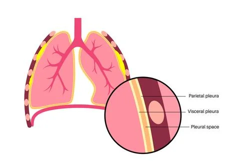 Pleural plaque poster Stock Illustration