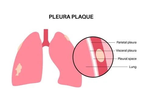 Pleural plaque poster Stock Illustration