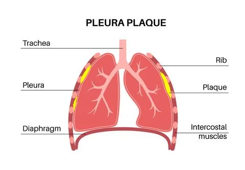 Pleural plaque poster Stock Illustration