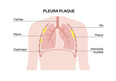 Pleural plaque poster Stock Illustration
