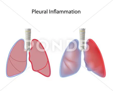 Pleurisy Stock Illustration