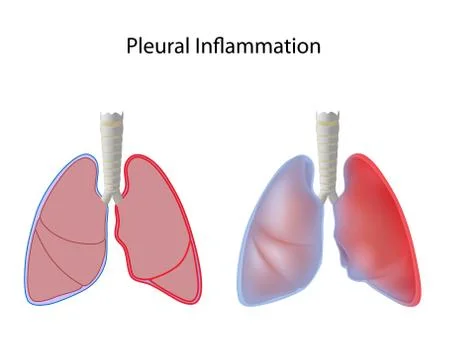 Pleurisy Stock Illustration