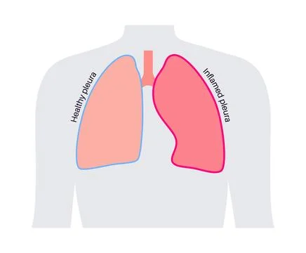Pleurisy inflammation diseases 库存插图