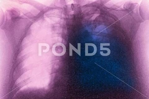 PLEURISY X-RAY Pleurisy (left lung), seen on a frontal chest x-ray ...