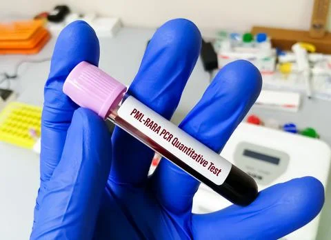 PML-RARA quantitative test in PCR laboratory. promyelocytic Leukemia. Foto stock