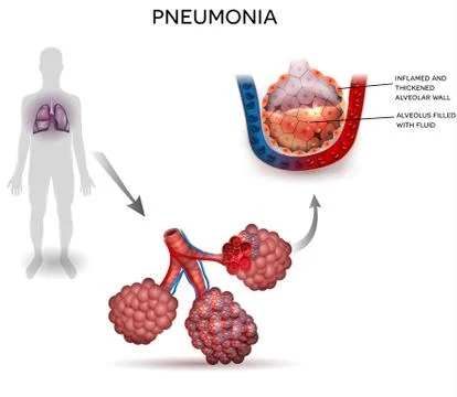 Pneumonia Stock Illustration