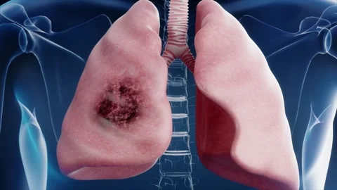 Pneumonia, right lung damage, lung cancer, smoker's disease Stockbeeldmateriaal 345014715