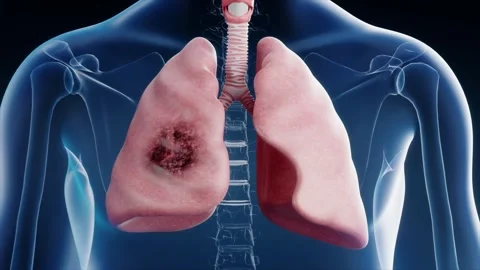 Pneumonia, right lung damage, lung cancer, smoker's disease Stockbeeldmateriaal 345015021