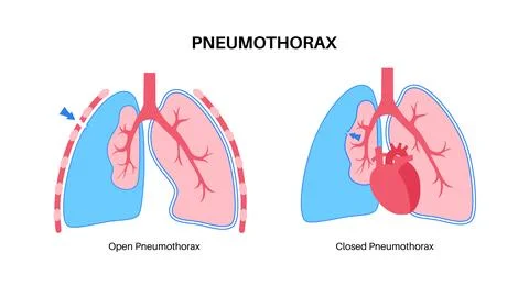 Pneumothorax anatomical poster Stock Illustration