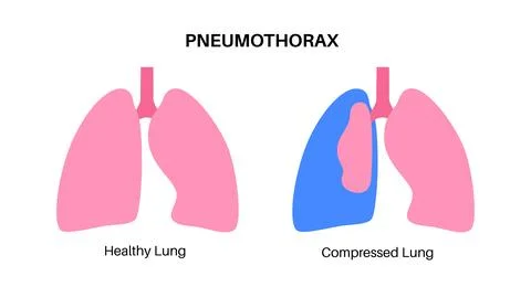 Pneumothorax anatomical poster Stock Illustration
