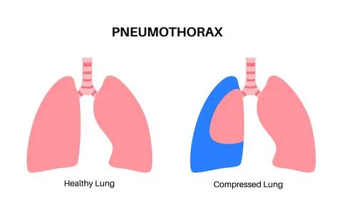 Pneumothorax anatomical poster Stock Illustration