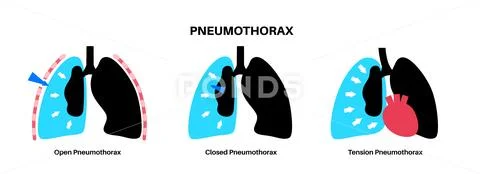 Pneumothorax anatomical poster: Graphic #238480729