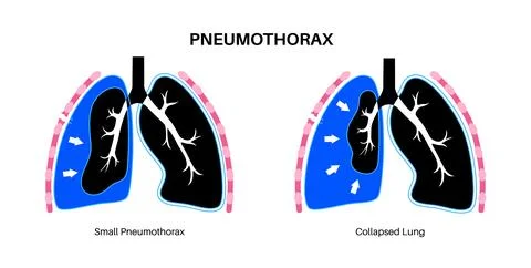 Pneumothorax anatomical poster Stock Illustration
