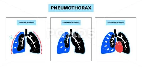 Pneumothorax anatomical poster: Graphic #238708429