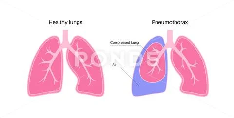 Pneumothorax anatomical poster: Graphic #238876073