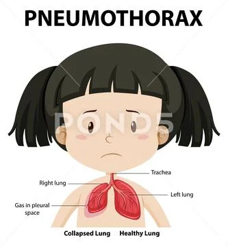 Pneumothorax diagram of human anatomy: Graphic #160527401