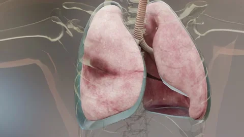 Pneumothorax, Normal lung versus collapsed,  symptoms of pneumothorax Stock Footage 155990058