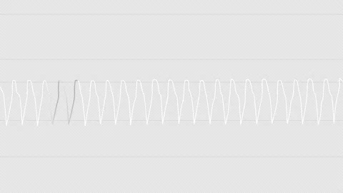 PNG Alpha.ECG looping.Vtach. Vídeos de archivo 137809870