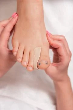 Podiatrist inserts a silicone impression between the toes to correct the ingr Foto stock