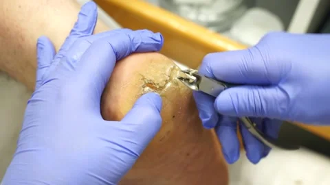 Podologic pedicure 2 Stock Footage 178443012