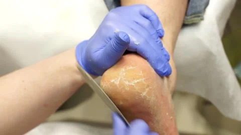 Podologic pedicure 5 Stock Footage 178441563